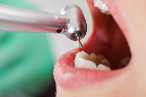 Best Emergency Tooth Extraction in Henry, IL